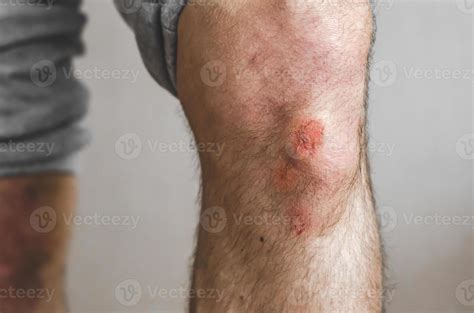 Scraped Knee Stock Photos, Images and Backgrounds for Free Download