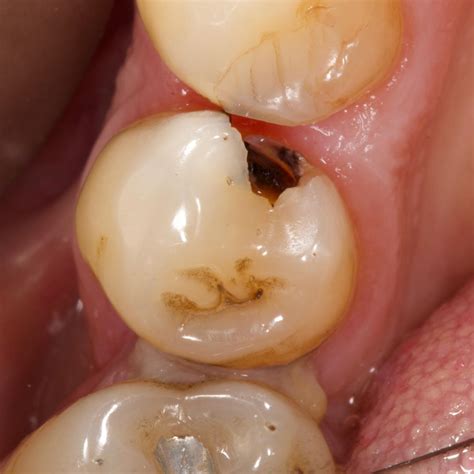 deep class ii carious    premolar