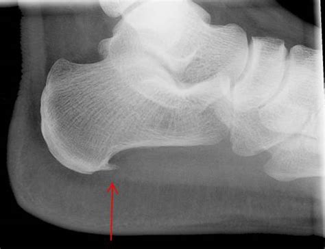 Bone Spurs: Causes, Symptoms and Treatment