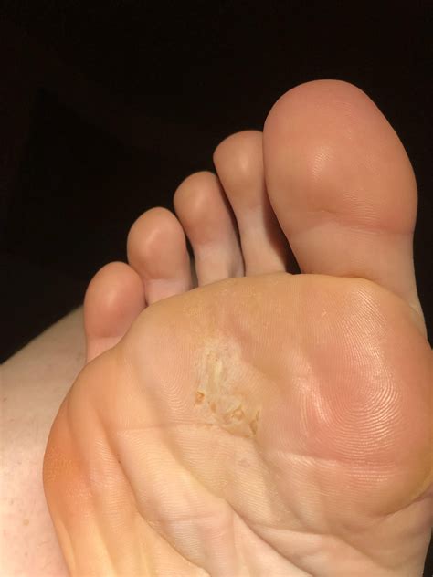 Duct tape is the answer to warts on bottom of foot : r/Warts
