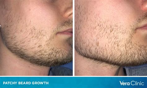 Patchy Beard Growth: A Comprehensive Guide