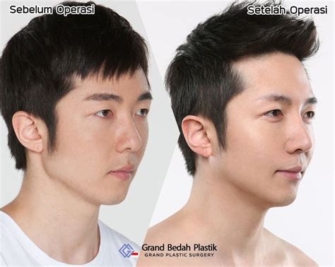 nose surgery  men