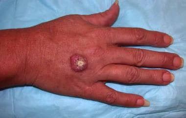 keratoacanthoma | Chandigarh Ayurveda and Panchakarma Centre