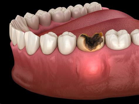 dental infection symptoms