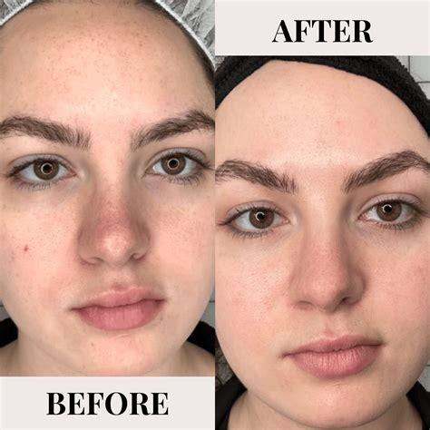 Laser Skin Resurfacing | edgebrookdermatology