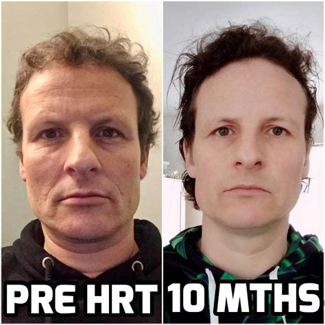 The Power Of HRT On The Face - Before And After 10 Months HRT : AskMtFHRT