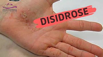 O Que É Bom Para Disidrose - O que é bom para acabar com a disidrose?