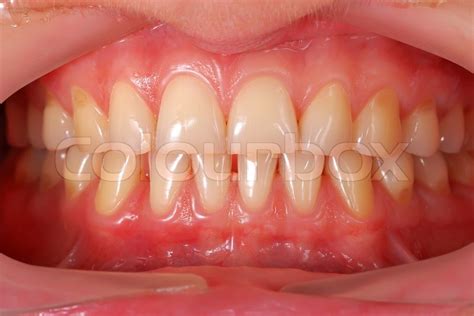 Human teeth | Stock image | Colourbox