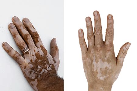 Vitiligo | Warren, OH | Warren Dermatology and Mohs Surgery