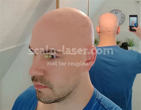 basic information  scalp laser hair removal kopfhaare weglasern
