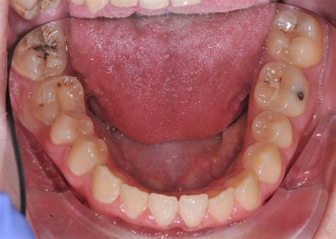 Cavity Side Of Molar