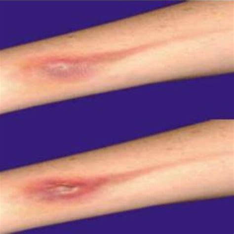 -Exemplo de Flebite Bacteriana. | Download Scientific Diagram
