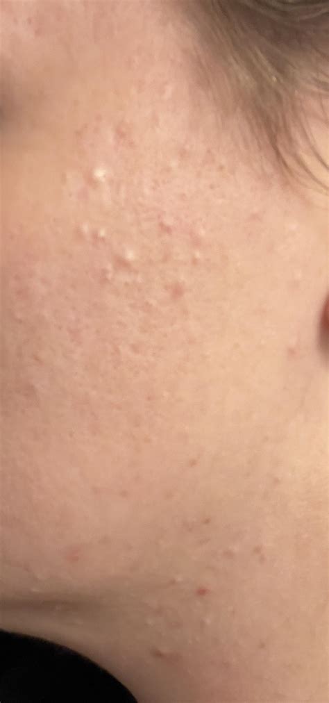 Bumps on face that have been there for years that I’m insecure about ...