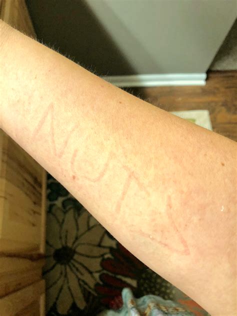 Why Dermographism Woke Me