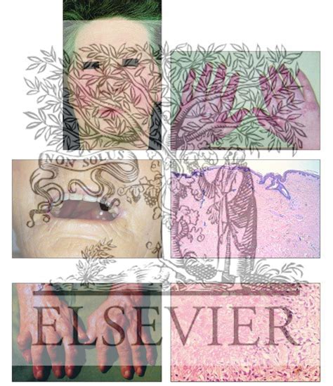 Collagen-Vascular Disease