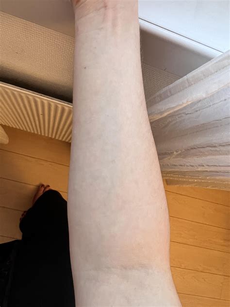 how to get rid of cherry angiomas at home 1