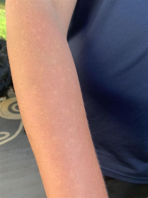 Contact dermatitis? Heat rash? Granuloma annulare? More in comments