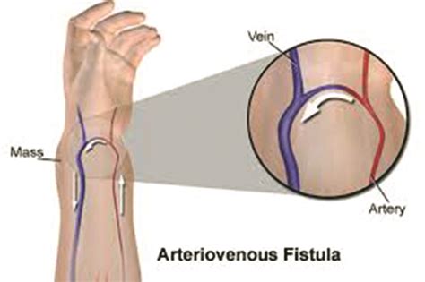 Fistula - Dijaliza