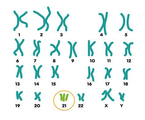 New research into the causes of Down’s syndrome - Downs Syndrome