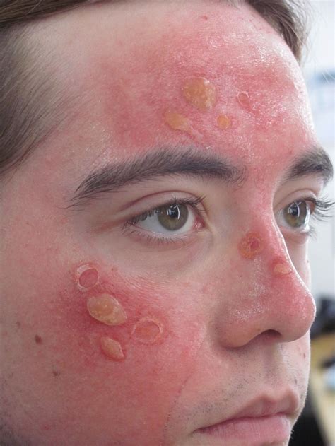 Sunburn Blisters Nose