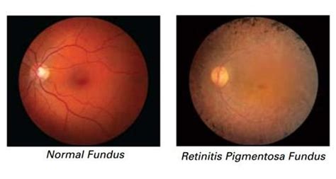 Retinitis Pigmentosa - Home