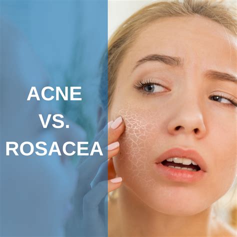Acne vs. Rosacea: What's the difference?