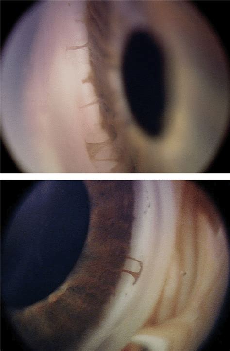 Two gonioscopic photographs demonstrating posterior embryotoxon and... | Download Scientific Diagram