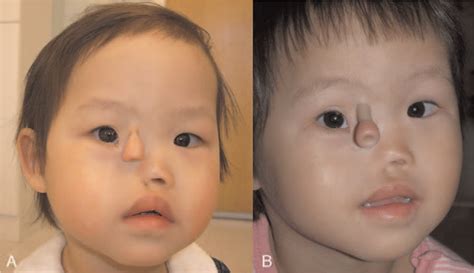 Proboscis Lateralis: A Novel Surgical Technique Using Tape E ...
