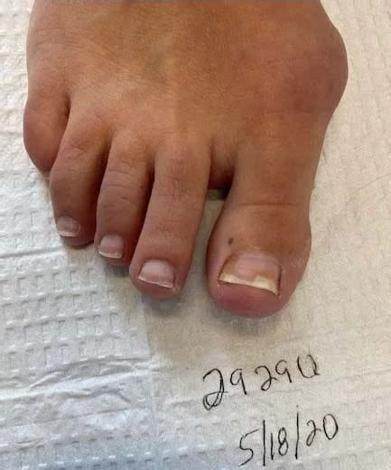 Toenail Fungus Before and After Photos - Advanced Podiatry of Manhasset ...