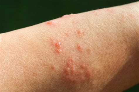 What Does Poison Ivy Rash Look Like? Symptoms to Know | SELF