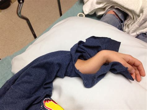 wash    broken arm  daniel shears blog