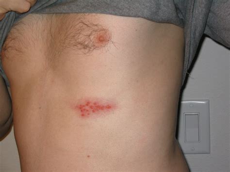 shingles herpes zoster geeky medics
