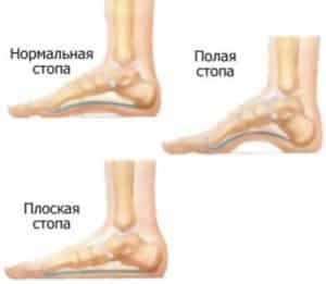 Высокий подъем стопы у человека: что такое поперечный и продольный свод ...