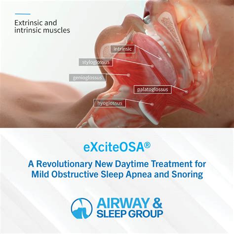 eXciteOSA® Therapy | Airway & Sleep Group