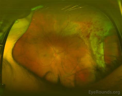 Retinal Dialysis