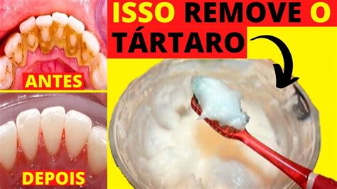Tirar Tartaro Em Casa - Como Remover Tartaro Cachorro Em Casa - Dibujos Cute Para Imprimir