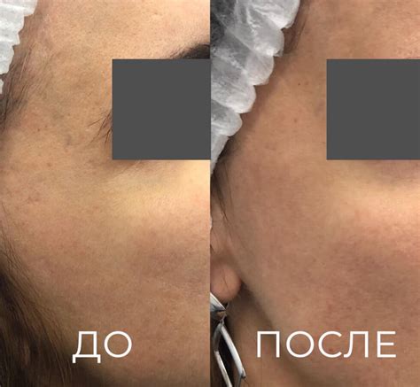Микроигольчатый RF-лифтинг (РФ Лифтинг) в Симферополе