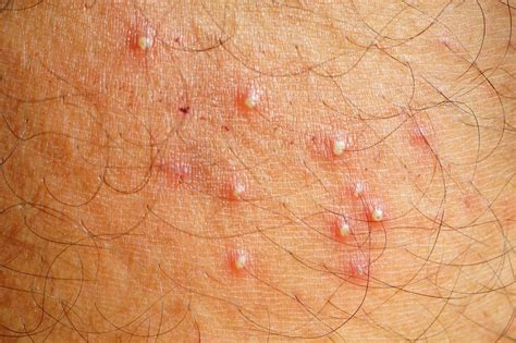 Folikulitas: Priežastys, Simptomai ir Gydymo Metodai | iDerma