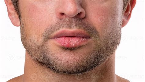 Raised Dry Spot On Lip - Infoupdate.org