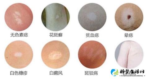 汗癣的症状的图片 汗癣会不会传染给别人 - 醉梦生活网