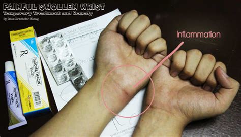 Home Remedy and Treatment for Painful Swollen Wrist - Medicines and ...