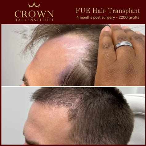 FUE Hair Transplant in Beverly Hills, CA | FUE Hair Transplant