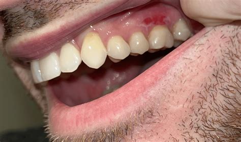 Canker sore on gum? : r/CankerSores