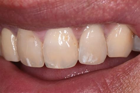 faccetta  ceramica su  caso clinico