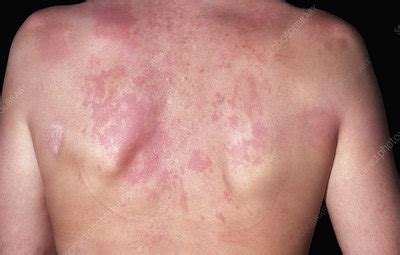 Morphea - Stock Image - C052/2506 - Science Photo Library