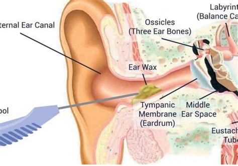 Ear Wax Removal Using Microsuction | Clear Ears Clinic