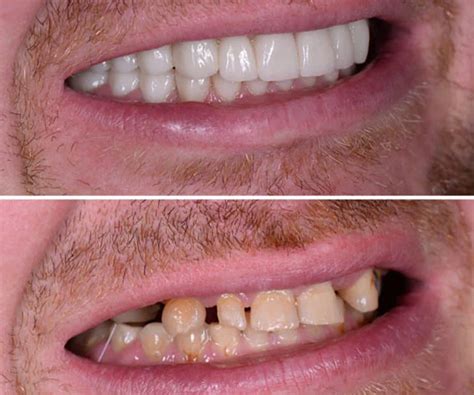 Smile Gallery - Flossy Smiles Dental Implants & Esthetics