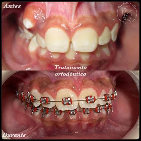Aparelho Ortodôntico Antes E Depois - Damon Aparelho Antes E Depois Caso Clínico Correção Com