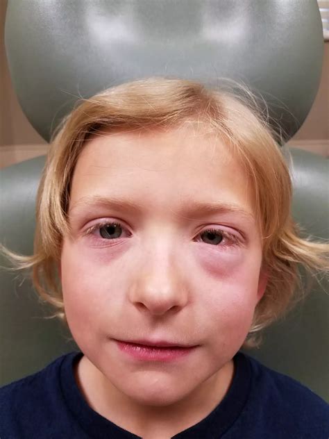 What Does Pink Eye Look Like? | Dr Farrah MD
