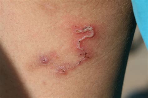 Hookworm infection, symptoms, diagnosis & hookworm treatment in humans